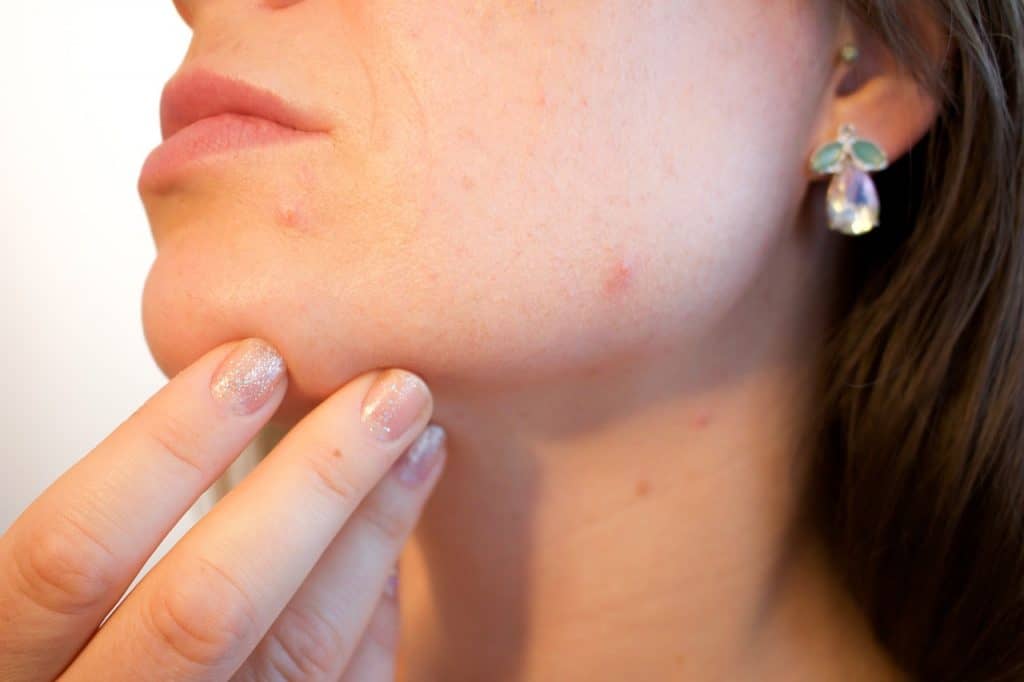 solucionar el acne