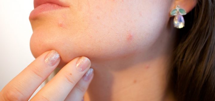 solucionar el acne